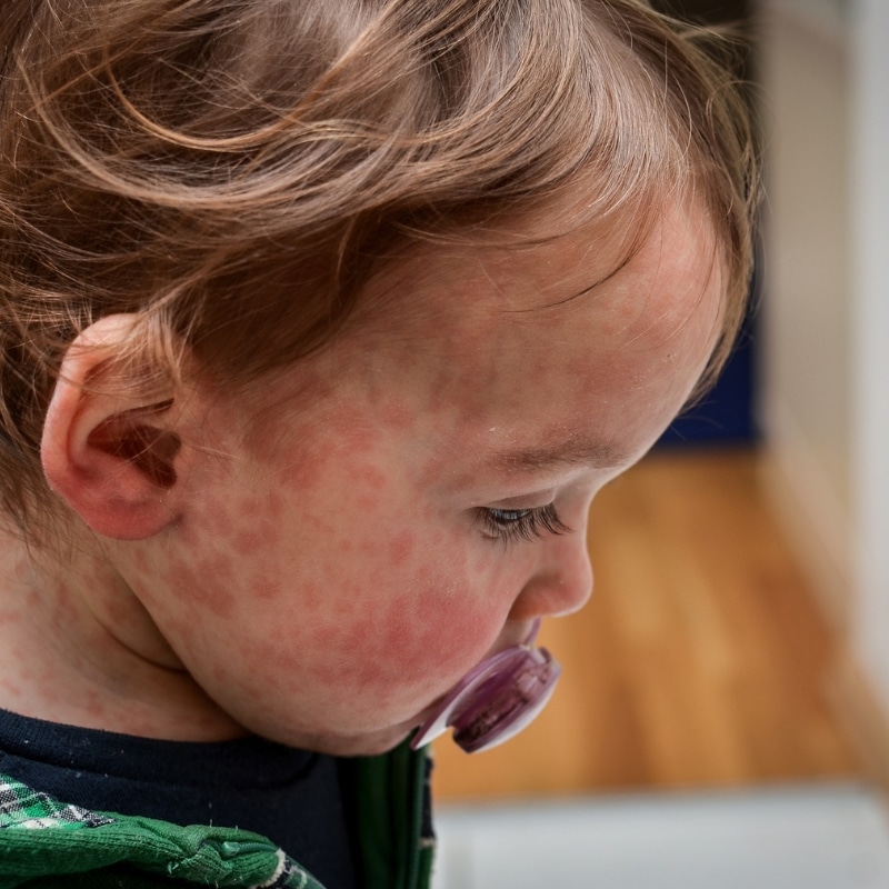 Measles Response Efforts, child with measles